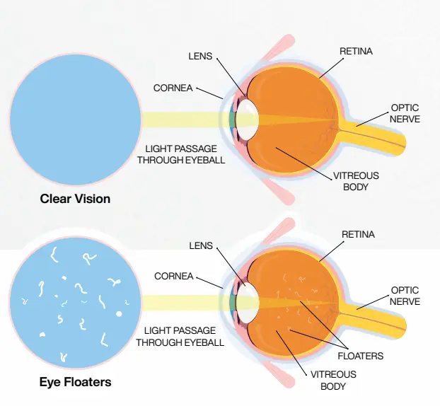 Illustration of vitreous fluid in the eye