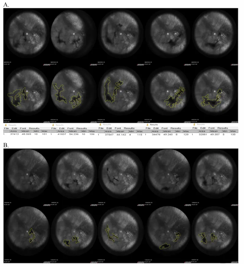 Illustration showing vitreous support